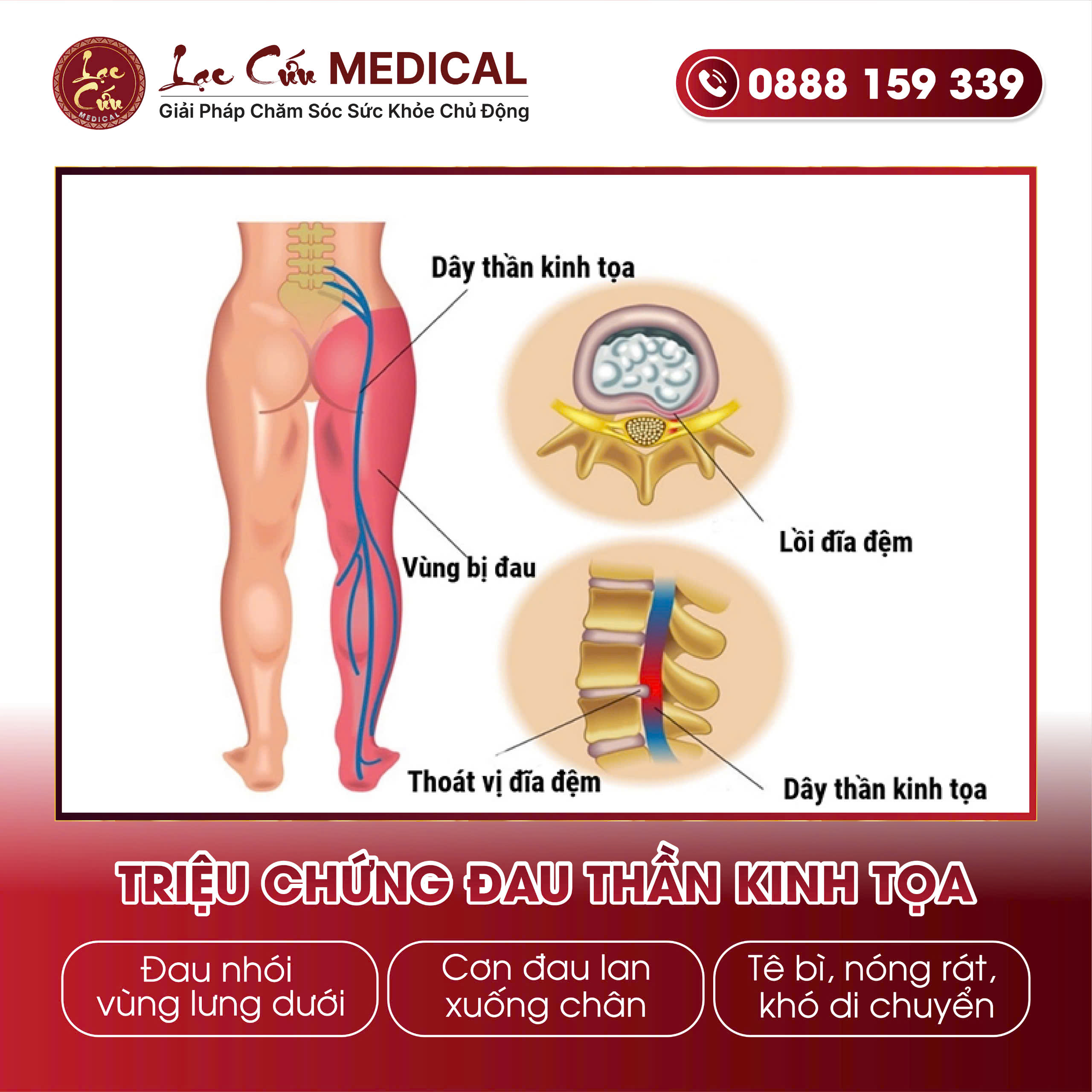 Triệu chứng Đau thần kinh tọa