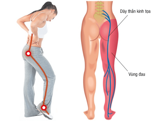 Đau thần kinh tọa là một bệnh lý gây đau dai dẳng từ thắt lưng xuống chân, làm suy giảm khả năng vận động