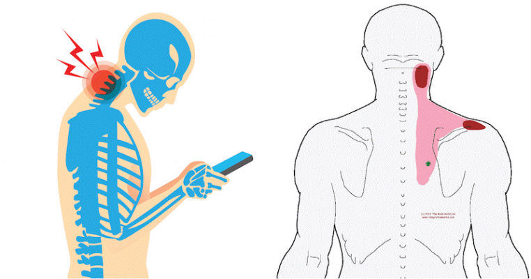 Hoạt động sai tư thế trong thời gian dài là nguyên nhân dẫn đến đau vai gáy