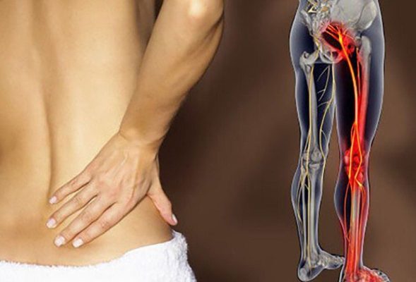 Có rất nhiều nguyên nhân dẫn đến đau thần kinh tọa kéo dài