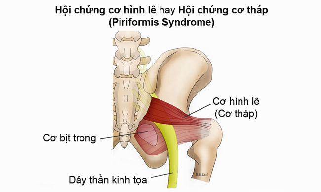 Cơ hình lê nằm ở mông có thể gây chèn ép dây thần kinh tọa