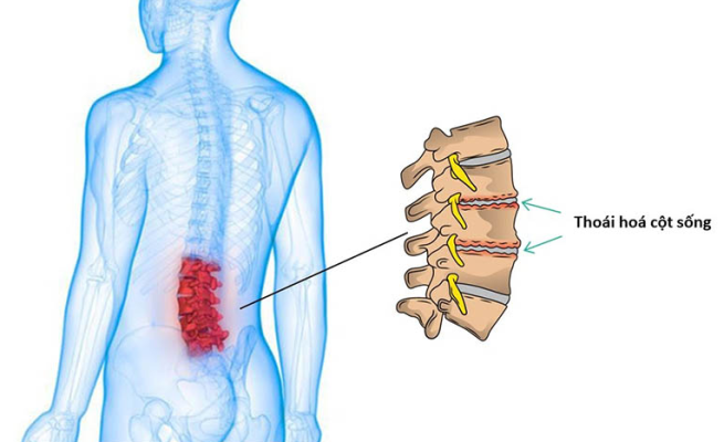 Không phát hiện và chữa thoái hóa cột sống sớm có thể gây ra hậu quả nghiêm trọng