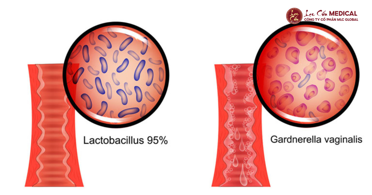 1. Vi Khuẩn Kỵ Khí (Bacterial Vaginosis – BV)_ Thường Xuyên Tái Phát