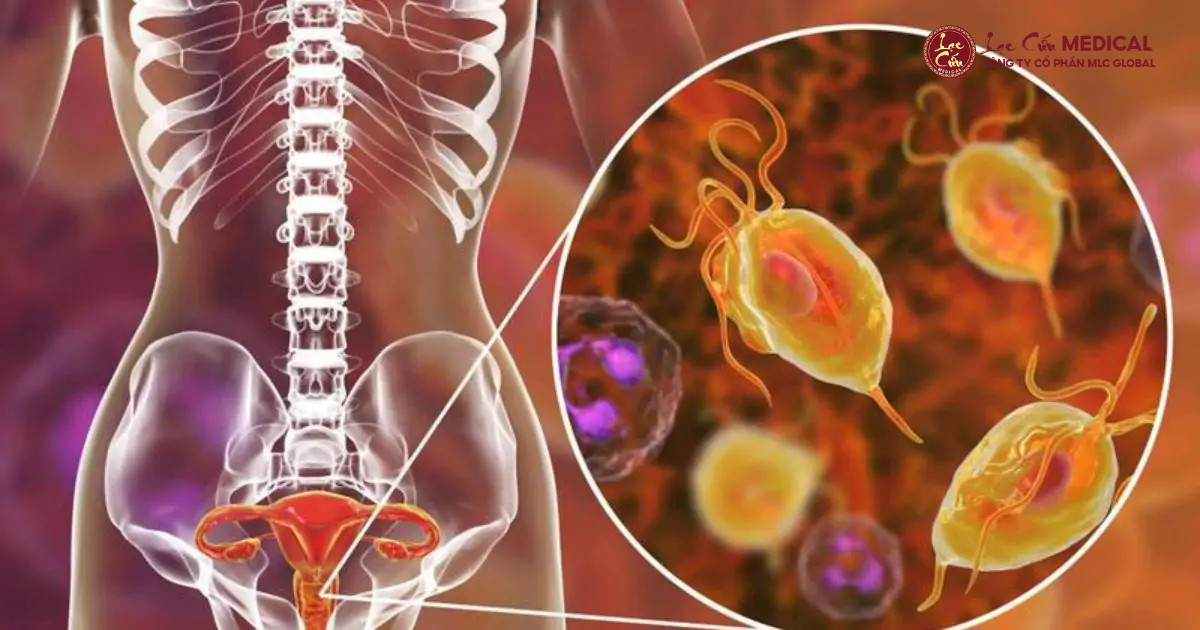 Trùng Roi Trichomonas