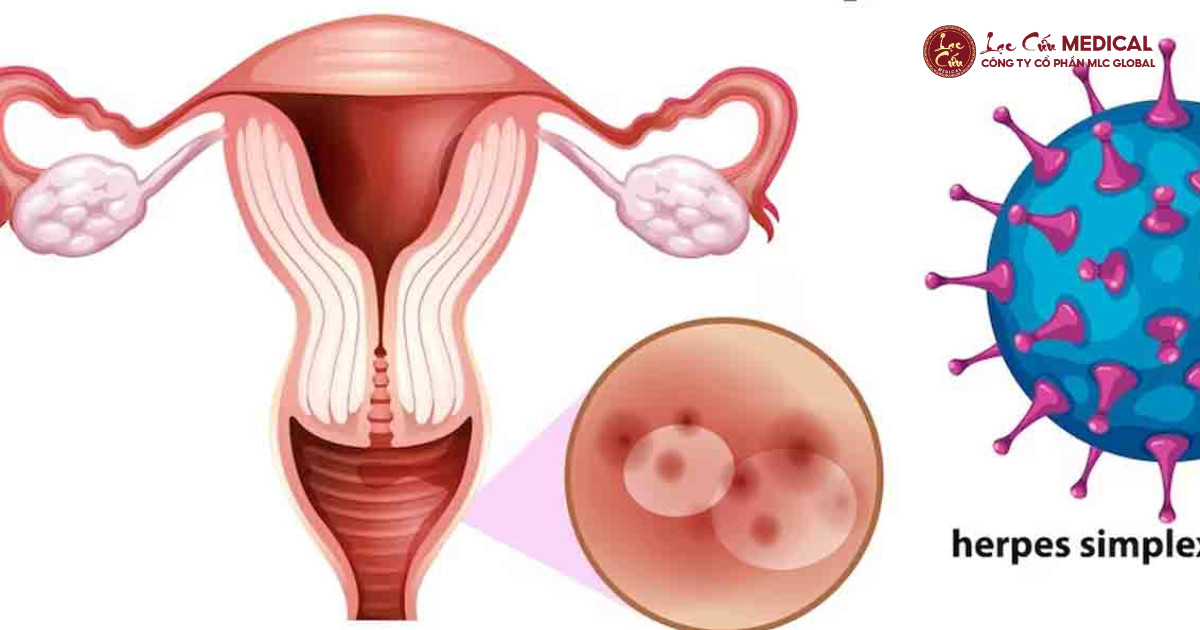 Virus (HSV, HPV...)_ Mối Lo Nguy Hiểm Tiềm Ẩn