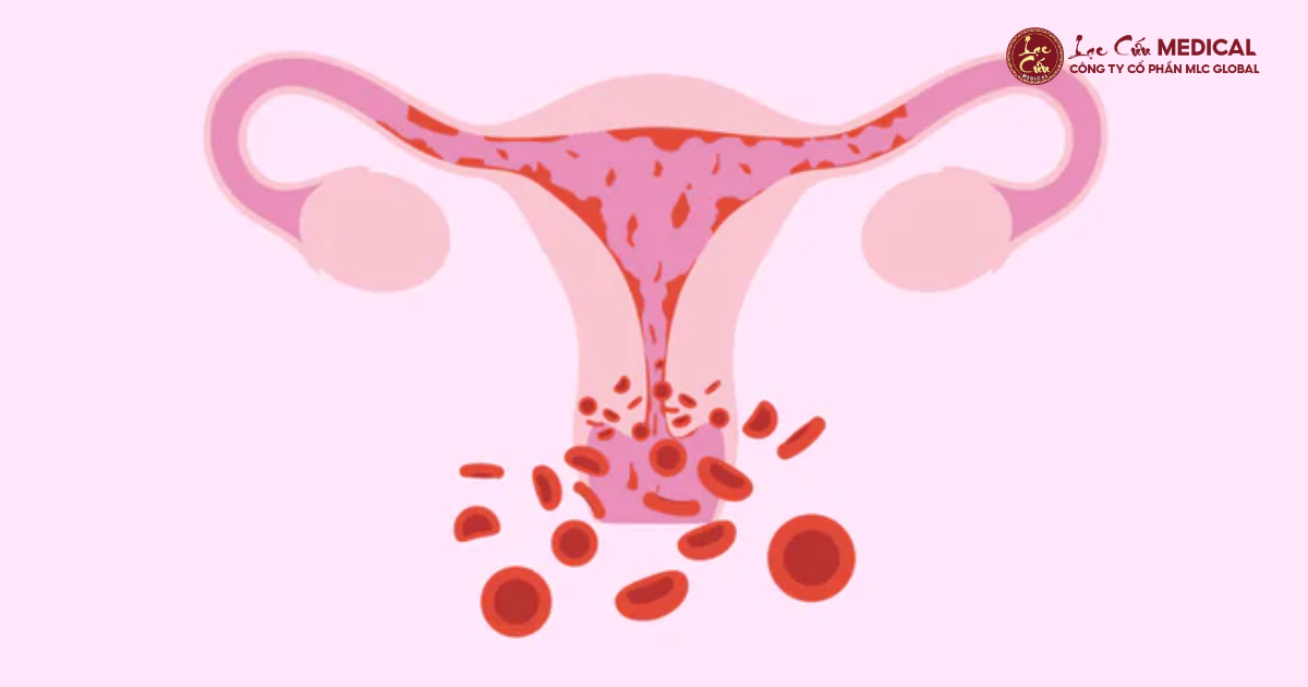 Bào Cung Hư Hàn__ Khi Nguồn Năng Lượng Nữ Tính Bị Đóng Băng