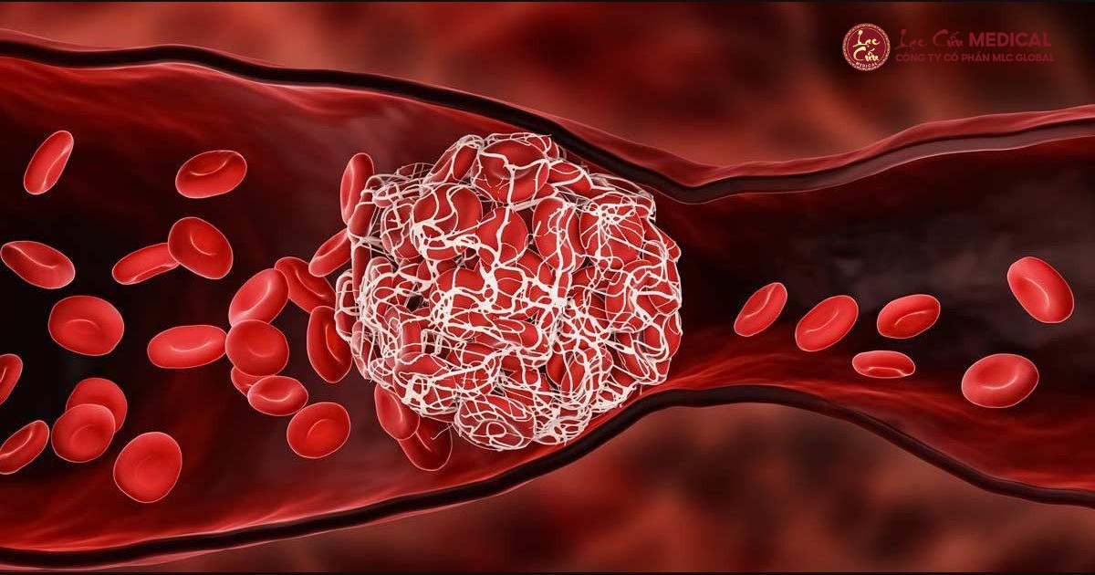 Mạch Máu Nghẽn, Sinh Mệnh Chỉ Còn Tính Bằng Phút_ Lời Cảnh Báo Âm Thầm