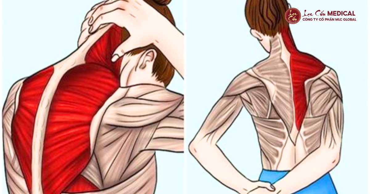 Cơ Trám Co Cứng_ Khi Vai Lưng Bị _Khóa Chặt