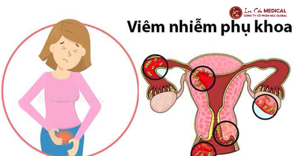 Vòng Luẩn Quẩn _Khỏi - Tái Viêm__ Nỗi Ám Ảnh Phụ Khoa