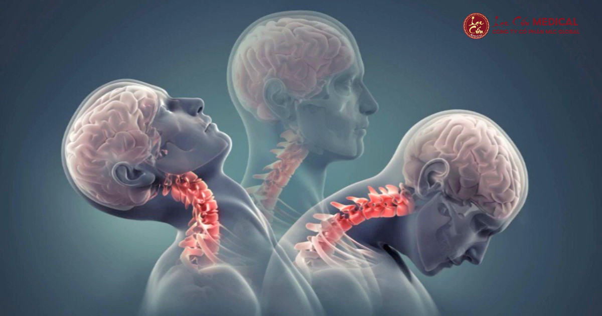 Cảnh Báo Những Hệ Lụy Nguy Hiểm Từ Cơn Đau Vùng Cổ