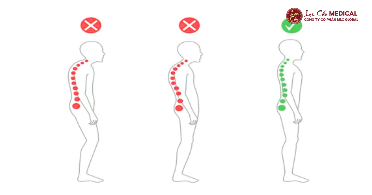 Cơ Bị Lệch Trục – Hệ Quả Của Thói Quen Sai Tư Thế