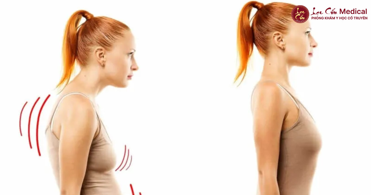 Gù Lưng – Cổ Rùa_ Khi Tư Thế Sai Trở Thành _Căn Bệnh_ Thời Đại