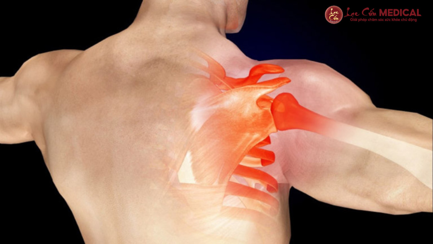 Khi Khớp Vai _Biểu Đình__ Nỗi Lo Không Của Riêng Ai