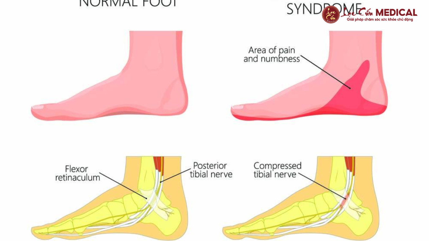 Nhận Diện Những Tín Hiệu _Cầu Cứu_ Từ Bàn Chân