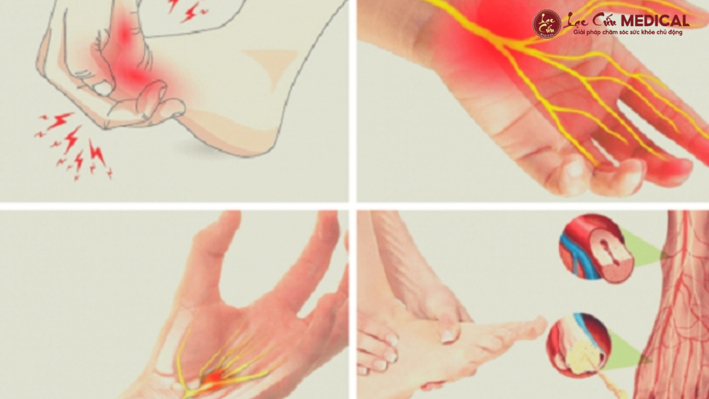 Nỗi Lo Tê Bì Tay Chân_ Không Chỉ Là Chuyện Của Người Già