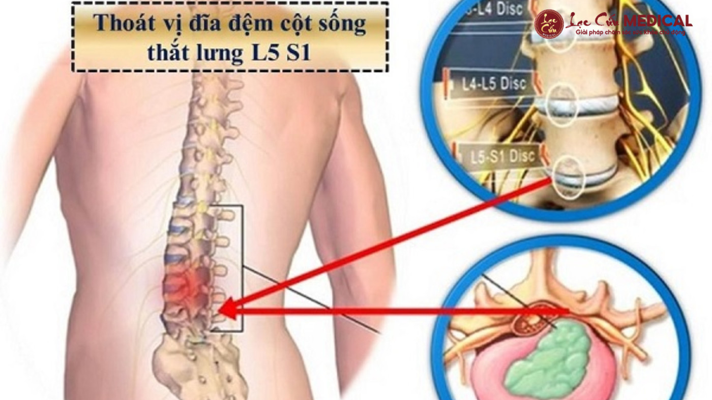 Thoát Vị Đĩa Đệm – _Căn Bệnh Thời Đại_ Của Mọi Lứa Tuổi