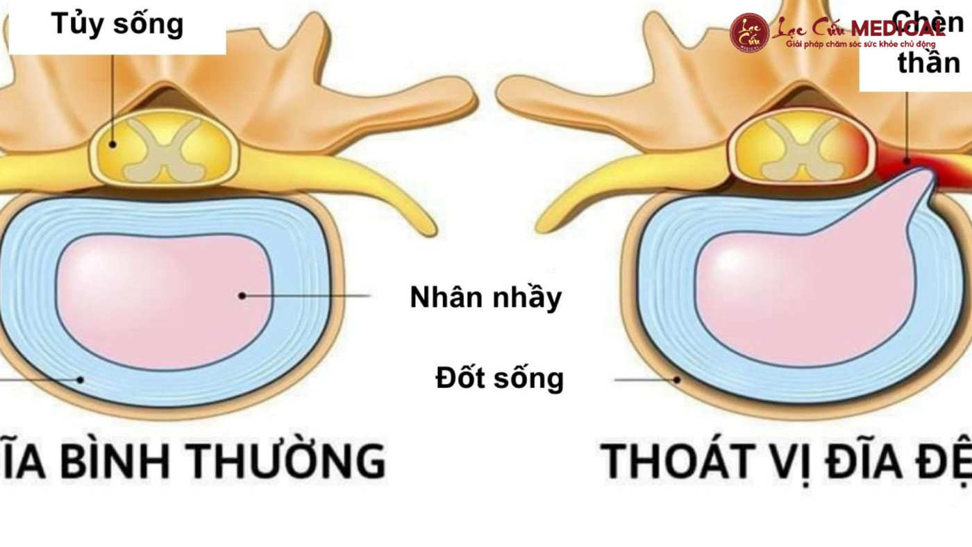 Vì Sao Đĩa Đệm Của Bạn Lại Trở Nên _Nghẹt Thở