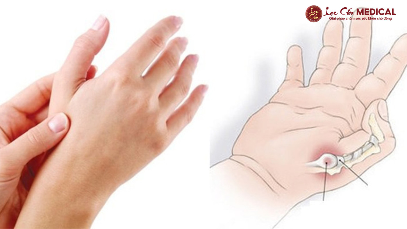 Dấu Hiệu Nhận Biết Viêm Gân Ngón Cái Đang Tiến Triển