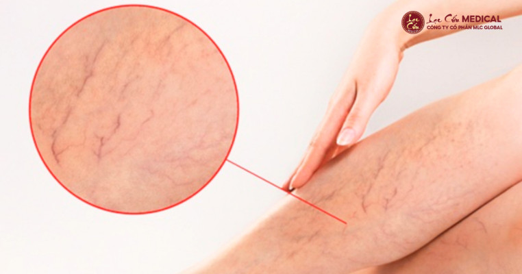 Suy Giãn Tĩnh Mạch – Kẻ Tàn Phá Âm Thầm Của Đôi Chân