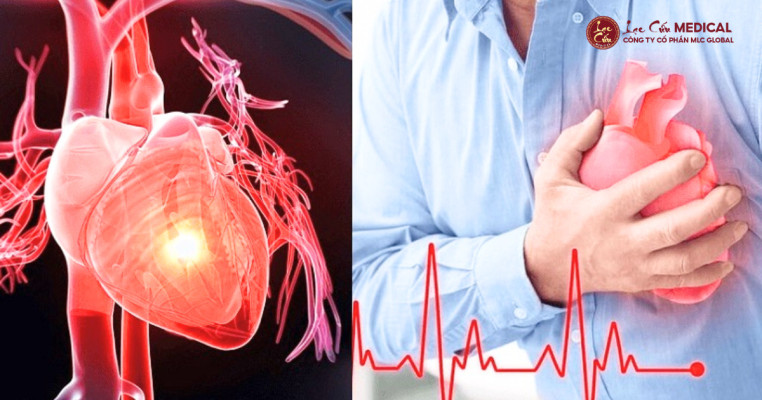 Tại sao dân văn phòng cần đặc biệt quan tâm đến tim mạch