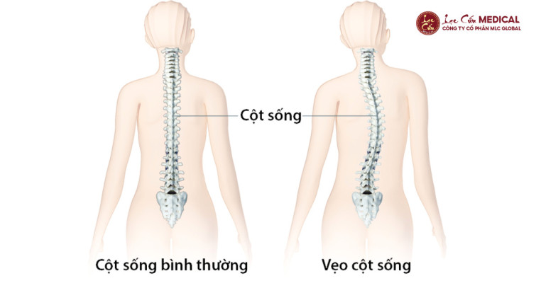 Vì Sao Cột Sống Bị Lệch_ Không Chỉ Là Chuyện Của Xương!