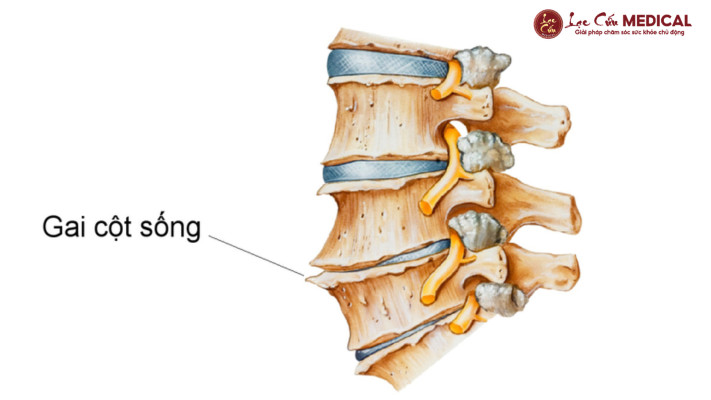 Gai Cột Sống_ Khi _Cái Gai_ Không Chỉ Nằm Ở Xương