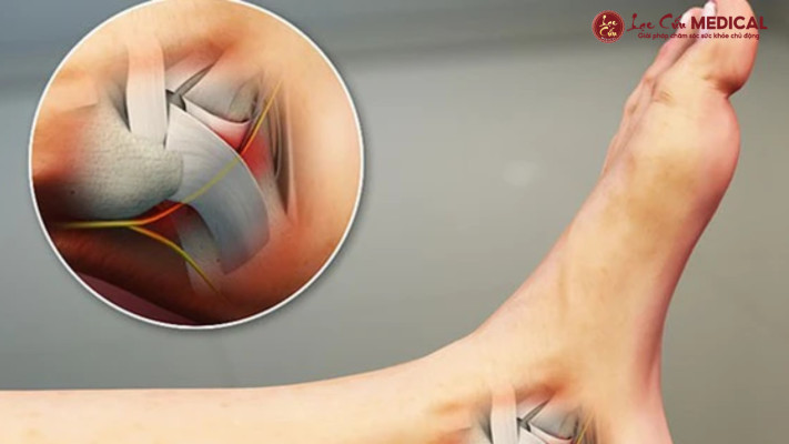 Hội Chứng Ống Cổ Chân_ _Kẻ Thù_ Thầm Lặng Của Đôi Bàn Chân