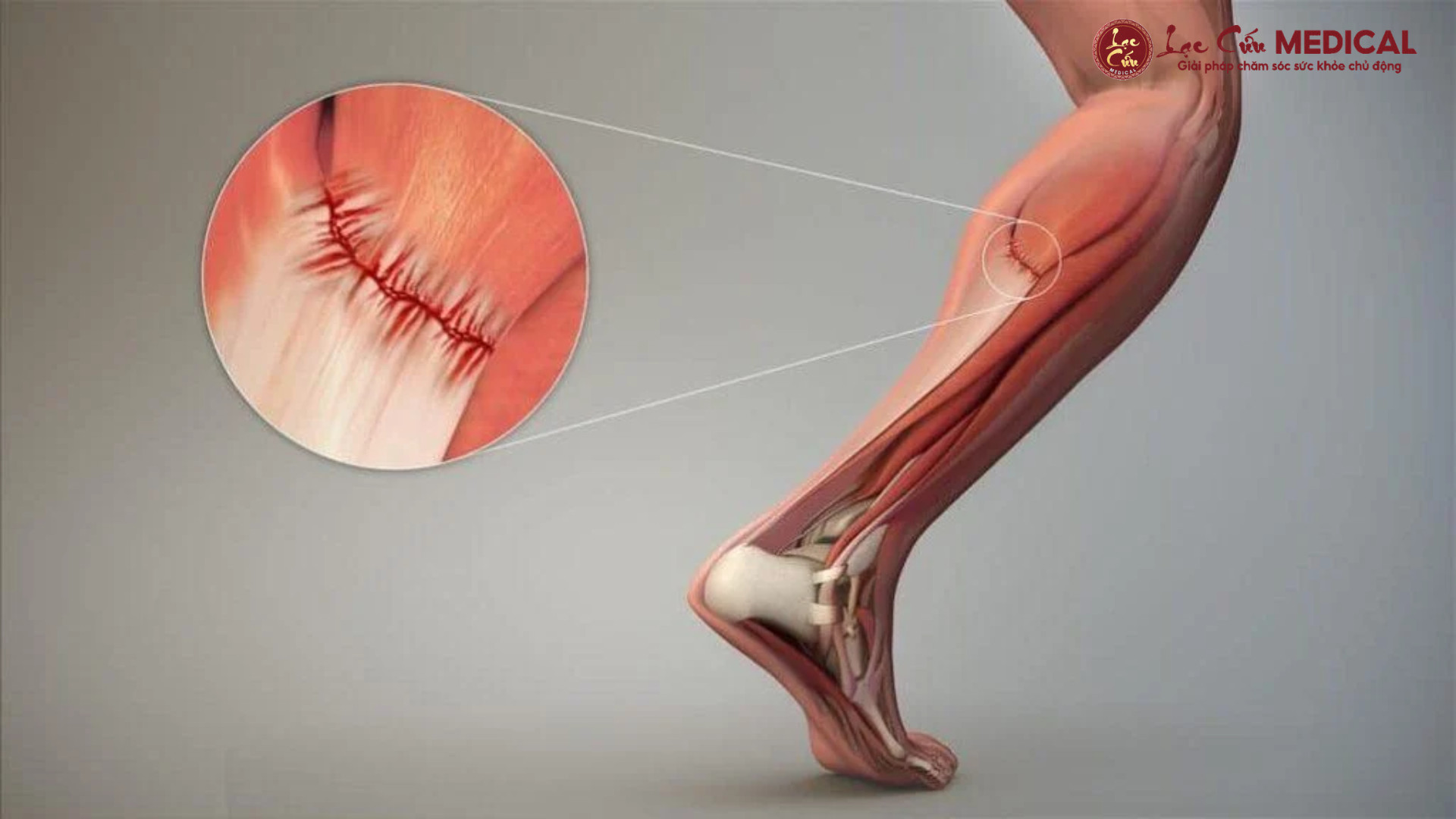 Căng Bắp Chân Sau Tập: Đừng Để Vi Chấn Thương Kéo Lùi